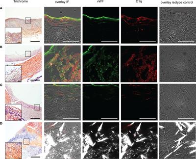 Complement C1q and von Willebrand factor interaction in atherosclerosis of human carotid artery